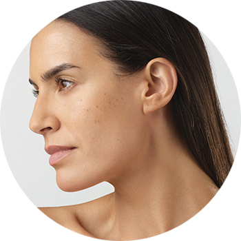 Dark spots-prone skin