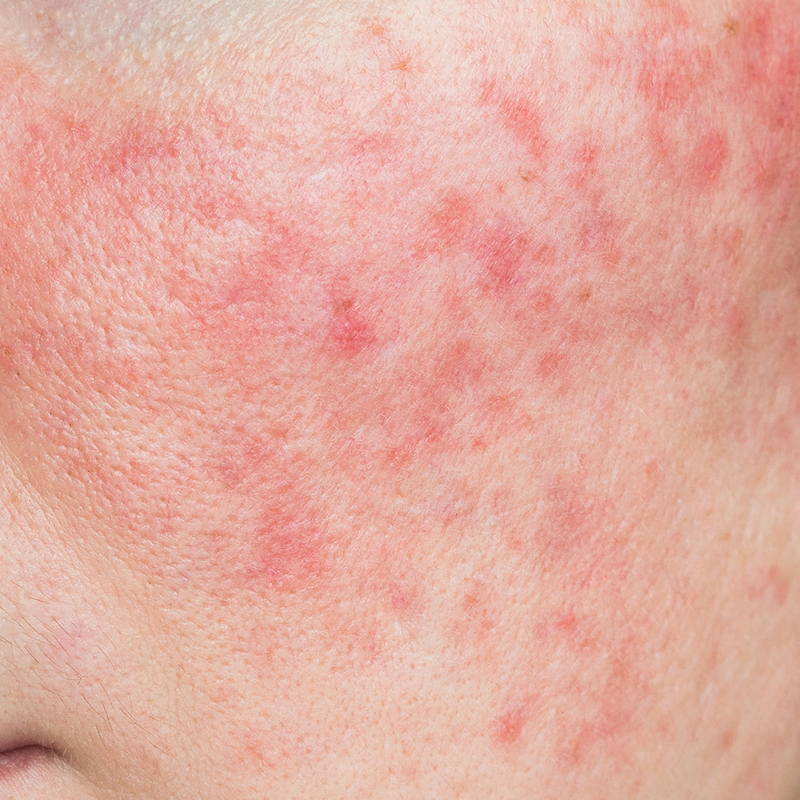 Rosacea