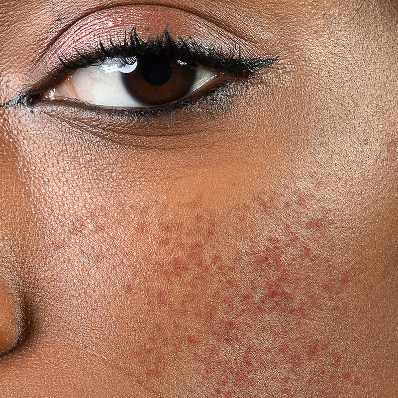 Dark skin showing visible signs of rosacea on her 